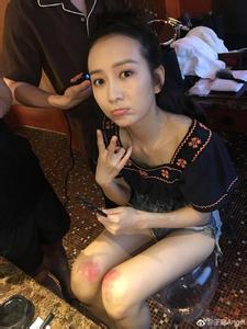 王鸥晒化妆间嘟嘴俏皮照 膝盖伤痕抢镜惹网友心疼